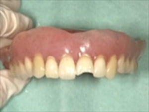 一部位の義歯、人工歯の歯折、毎日1-2時間の装着のみ可能