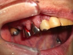 乾燥、光沢、粗造、発赤、部分的な（1-6歯分）腫脹、義歯下の一部潰瘍