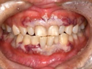 腫脹、出血（7歯分以上）、歯の動揺、潰瘍、白色斑、発赤、圧痛