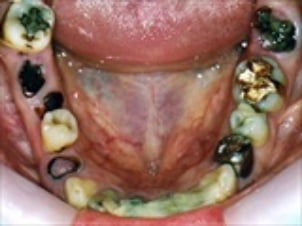 4本以上のう蝕、歯の歯折、残根、非常に強い咬耗、義歯使用無しで3本以下の残存歯