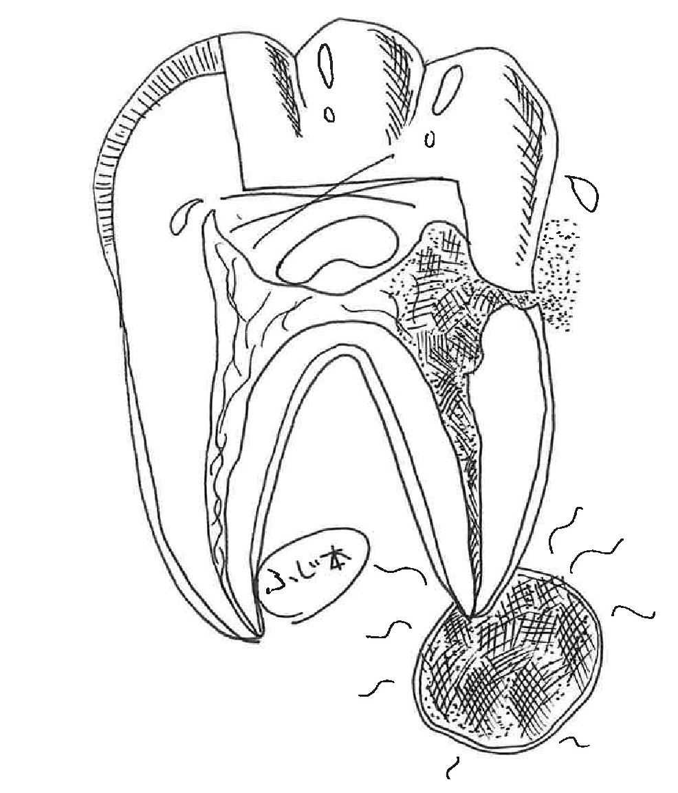 歯の一生（むし歯編）～萌出から喪失まで～